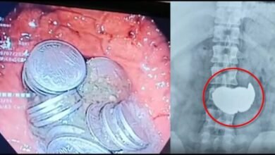 this-young-man-was-swallowing-coins-under-stress-after-a-month-and-a-half-the-doctor-removed-63-coins-from-his-stomach